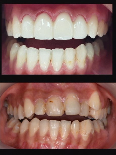 יישור שיניים חלקי ואימקס על רביעיה קדמית
