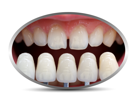 ציפוי שיניים למינייט - לפני/אחרי